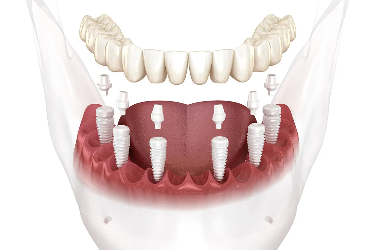 All-on-6 Dental Implants: 444