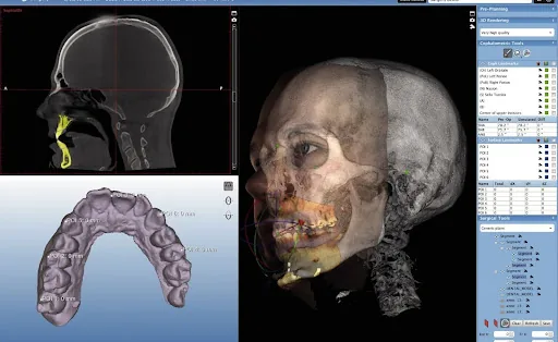 CBCT Scan: 111