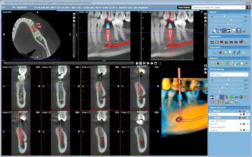 CBCT Scan: 333