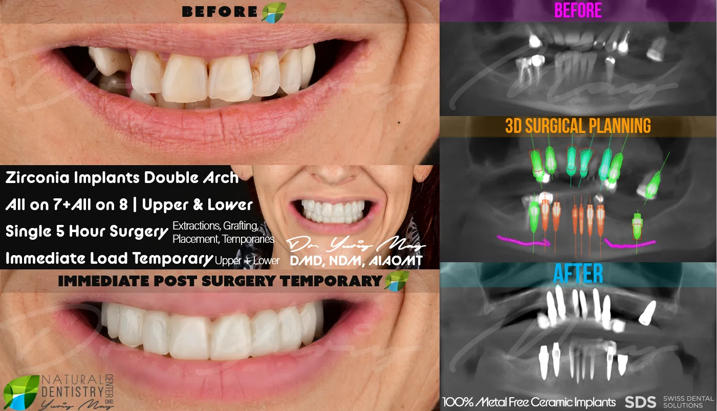ceramic dental implants: CERAMI1