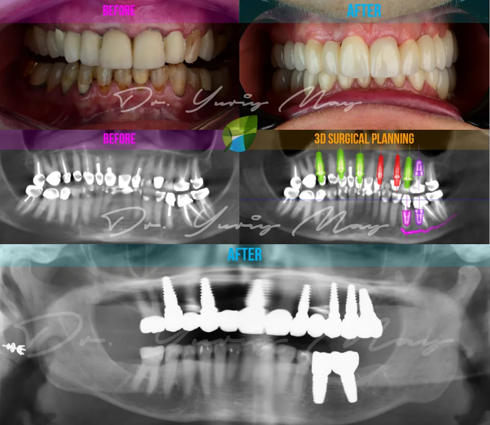 ceramic dental implants: CERAMI2