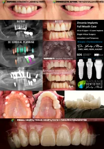 ceramic dental implants: Ceramic Implants Full Mouth All on 6 Zirconia Implants Dr. May Zirconia Implant Dentist 211x300 1