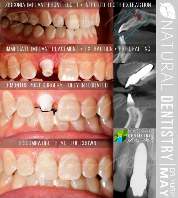 ceramic dental implants: Front Tooth Zirconia Implant Ceramic Implant Front Tooth Immediate Before and After Dr. Yuriy May Natural Dentistry