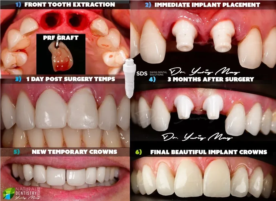 ceramic dental implants: Front Tooth Zirconia Implant Dentist Natural Dentistry Top Front Tooth Implant Dentist 1