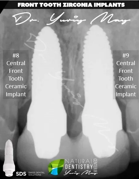 ceramic dental implants: Front Tooth Zirconia Implants Ceramic Implant Front Teeth Dr. Yuriy May Natural Dentistry