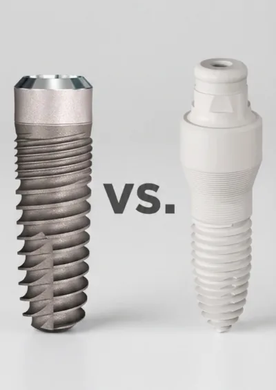 ceramic dental implants: Titanium vs Zirconia Image Generic