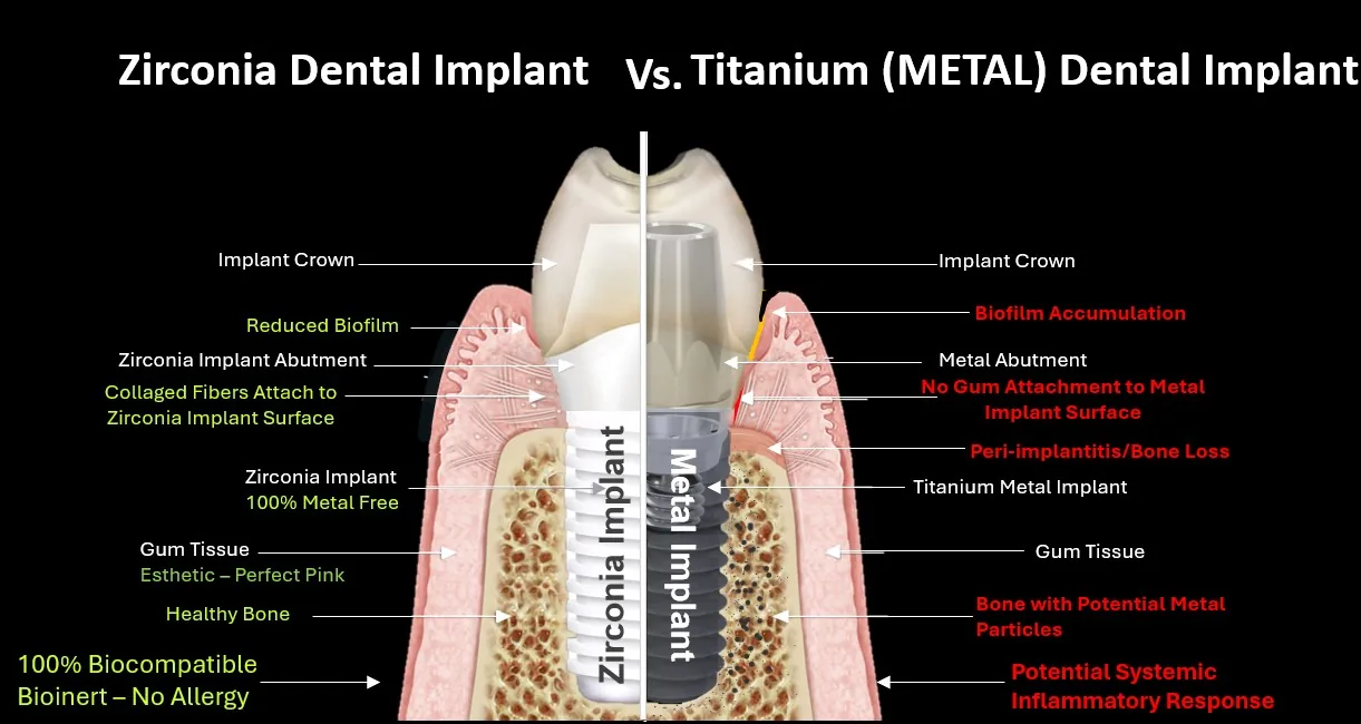ceramic dental implants: Titanium vs Zirconia Implant Image variation 2