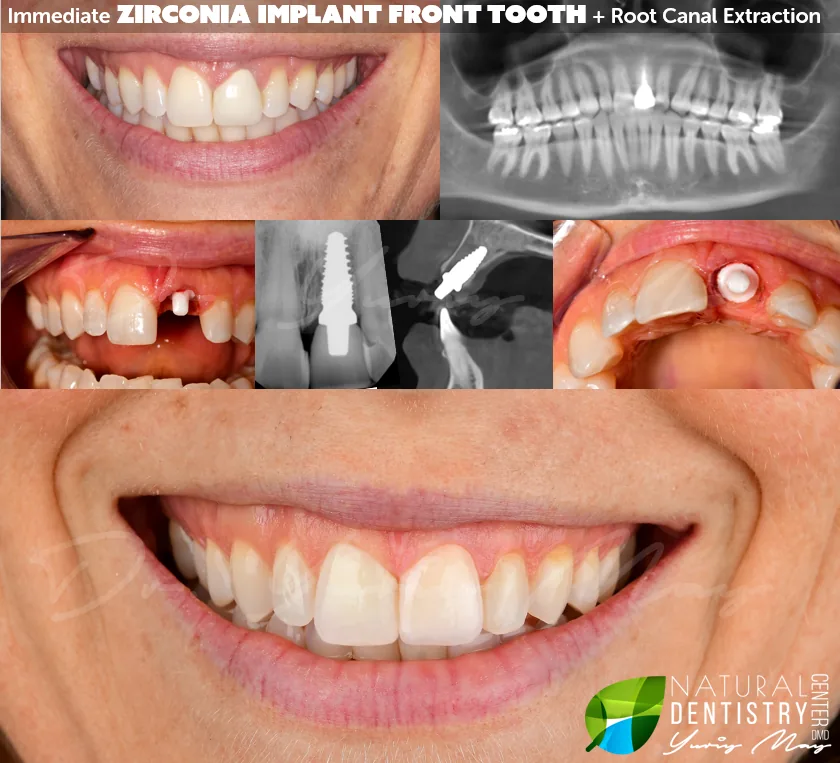 ceramic dental implants: Zirconia Dental Implant Front Tooth Natural Dentistry Ceramic Implant Before and After Dr. May