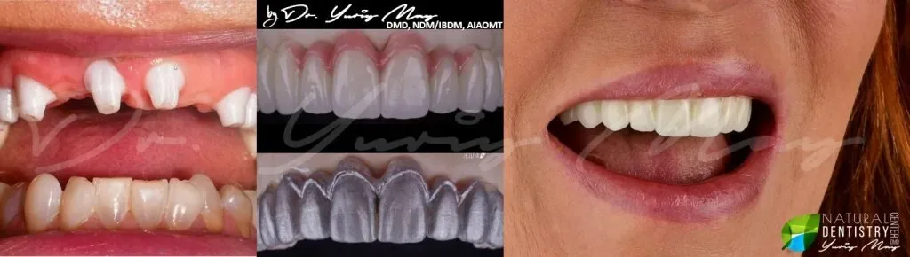 ceramic dental implants: Zirconia Dental Implants Full Mouth Ceramic Implants Before and After Dr. Yuriy May Natural Dentistry 1024x290 1