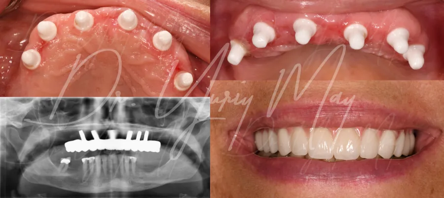 ceramic dental implants: Zirconia Full Arch All On 6 Dr. Yuriy May Full Mouth Reconstruction Metal Free Implants 2