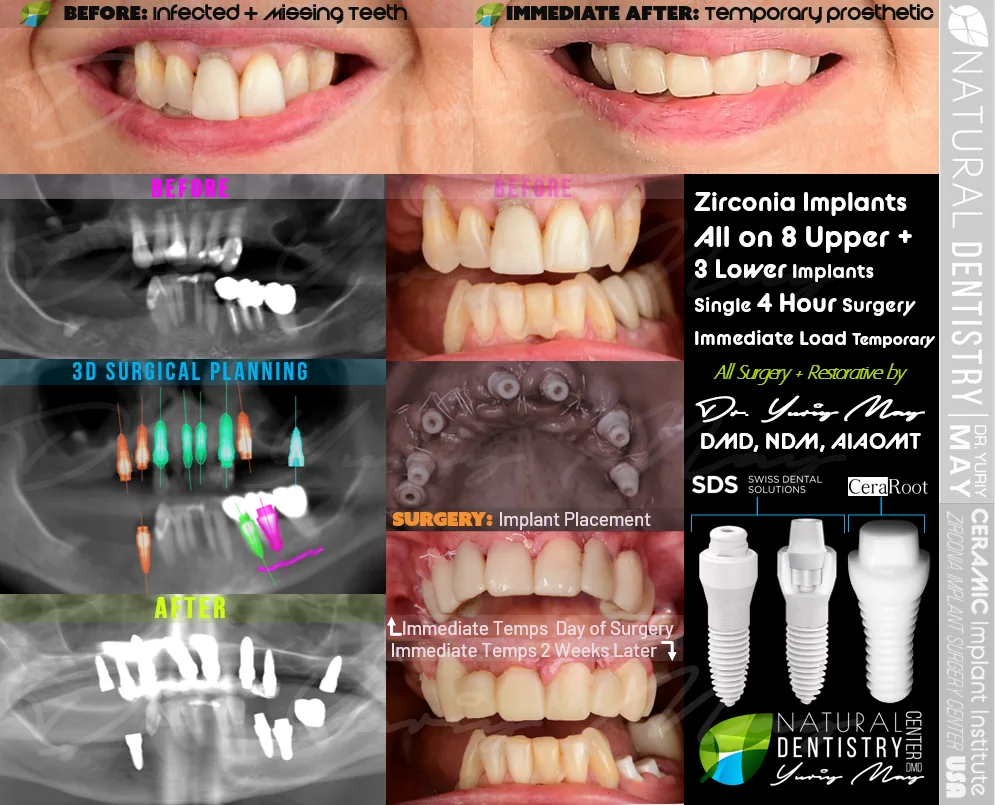 Zirconia Implant Full Mouth Reconstruction All on 4 Ceramic Dental Implants Dr. Yuriy May Best Zirconia Implant Dentist USA
