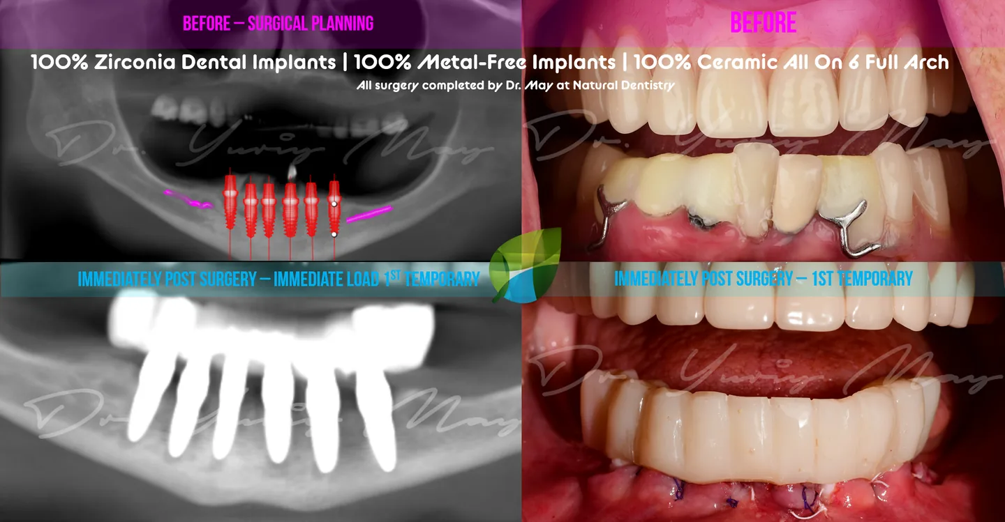 ceramic dental implants: Zirconia Implants Full Lower Arch All on 6 Ceramic Implants Dr. Yuriy May NY CT NJ MA USA 100 Metal Free