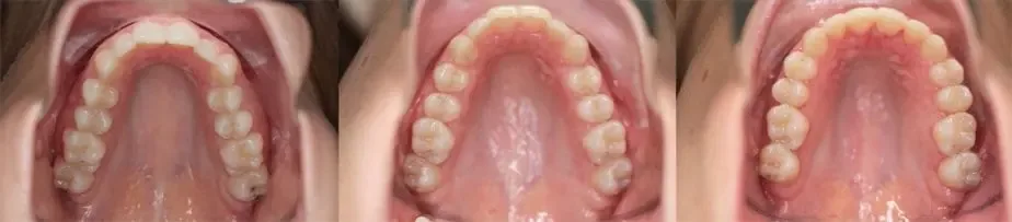 DNA Sleep Apnea Appliance: Obstructive Sleep Apnea OSA