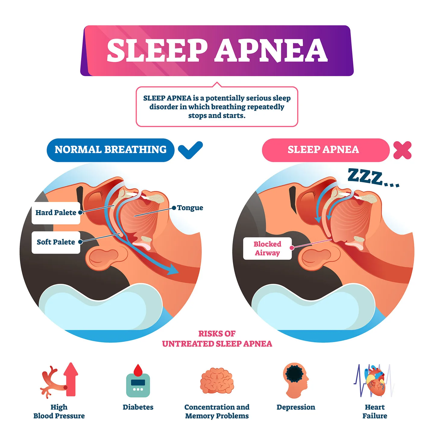 DNA Sleep Apnea Appliance: Sleep Apnea Treatment 2