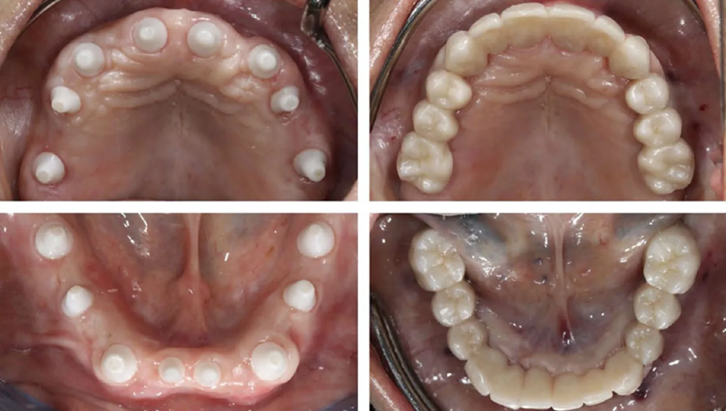 full arch zirconia implant bridge: SDS All on X Occlusal Examples