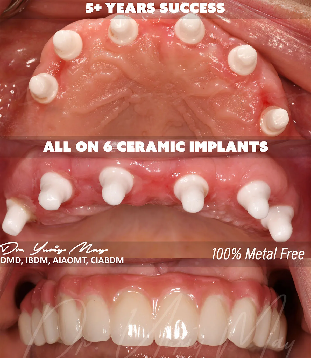 full arch zirconia implant bridge: Yelena AFTER