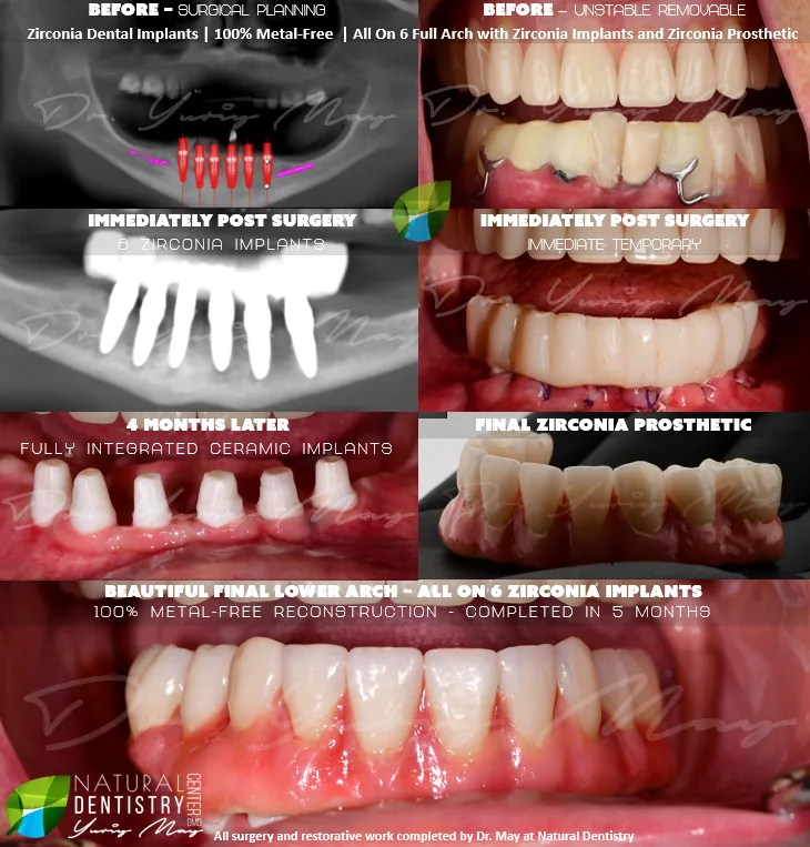 full arch zirconia implant bridge: Zirconia Implants Full Mouth Lower Arch All on 6 Ceramic Implants Dr. May Ceramic Implant Dentist