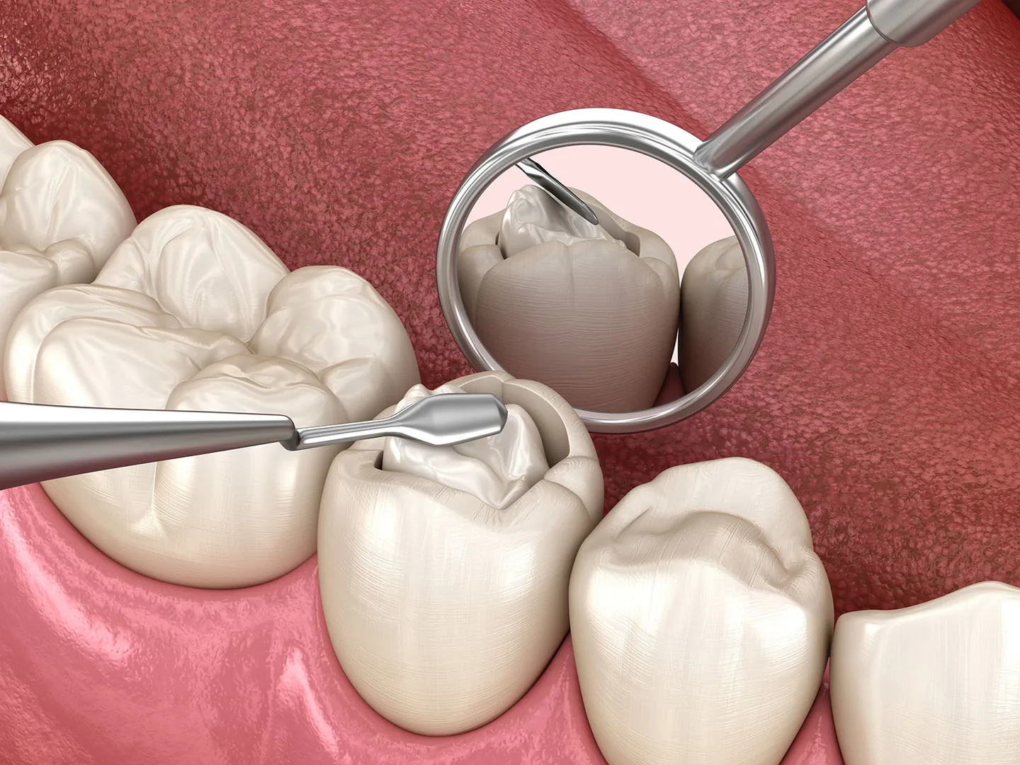 Non-Toxic Dental Fillings: non toxic dental fillings 2