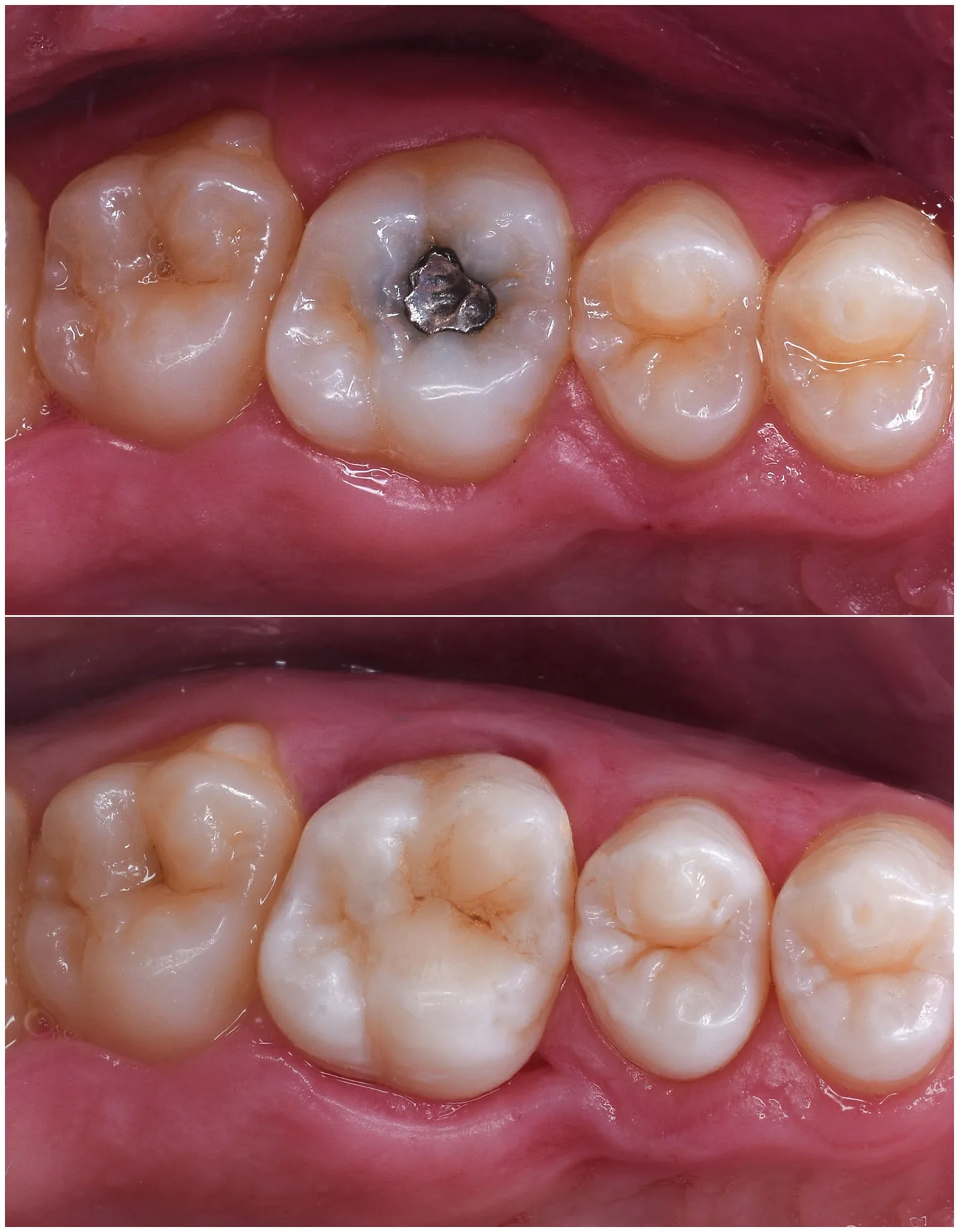 Non-Toxic Dental Fillings: non toxic dental fillings 3